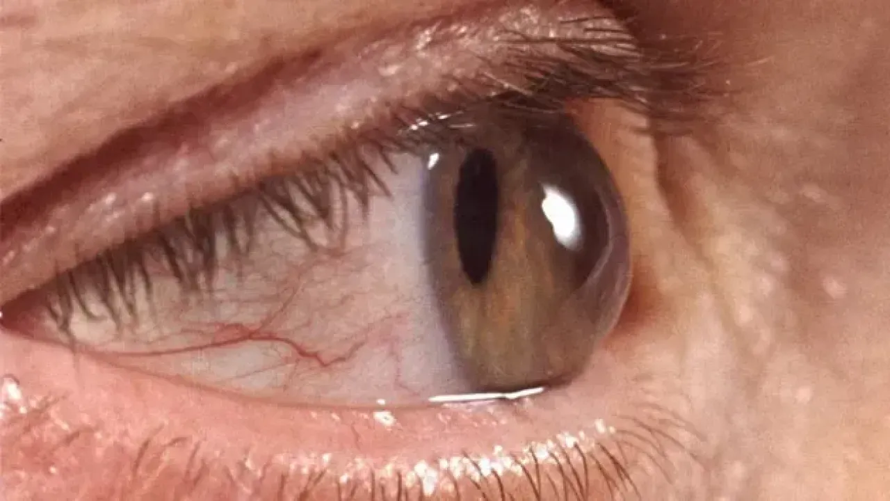 Kışla birlikte gelen göz enfeksiyonlarına dikkat! Uzmanından kritik uyarı…