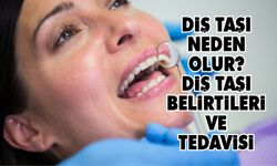 Diş Taşı Neden Olur? Diş Taşı Belirtileri ve Tedavisi