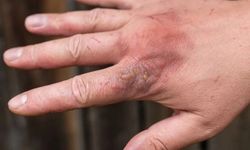 Uzmanlar açıkladı… Sosyal medya yanığı kalıcı iz bırakıyor!