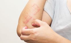 Alerjik egzama nedir? Belirtileri ve tedavisi