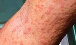 Çin'de 7 binden fazla "chikungunya" virüsü vakası tespit edildi