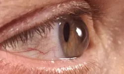 Kışla birlikte gelen göz enfeksiyonlarına dikkat! Uzmanından kritik uyarı…