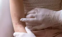 Uzmanından soğuk havalar öncesinde uyarı! O alışkanlıklar egzama hastalığını alevlendiriyor