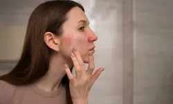 Kış aylarında görülen deri hastalıklarına dikkat! Uzmanından kritik uyarı…