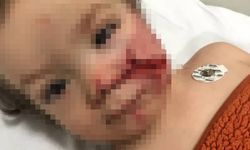 Bir pitbull dehşeti daha: İki kardeşe saldırdı, yüzü paramparça oldu!