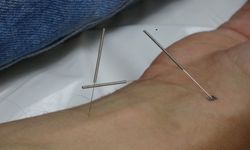 Gaziantep'te akupunktur ile sağlıklarına kavuştular