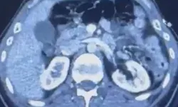 Zehir tacirlerine aman verilmiyor! Ülkeye midelerinde uyuşturucu getiren şahıslar yakayı ele verdi…