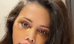 Didem Ceran kimdir, kaç yaşında, nereli? Survivor Didem Ceran neden ameliyat oldu?