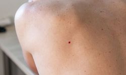 Derideki masum görünen benlere dikkat! önemli bir uyarı olabilir…