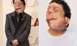 Adam Pearson Kimdir, Kaç Yaşında, Nereli? Nörofibromatozis Tip 1 Nedir, Yüzüne Ne Oldu, Hangi Filmlerde Oynadı?