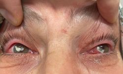 'Kırlangıç otu kullanımı'na dikkat! Uzmanlar uyarıyor: "Gözlerine suyunu damlattı, göremez hale geldi"