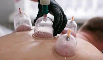 Hacamat uygulaması hekim kontrolü ve steril ortamda yapılmalı