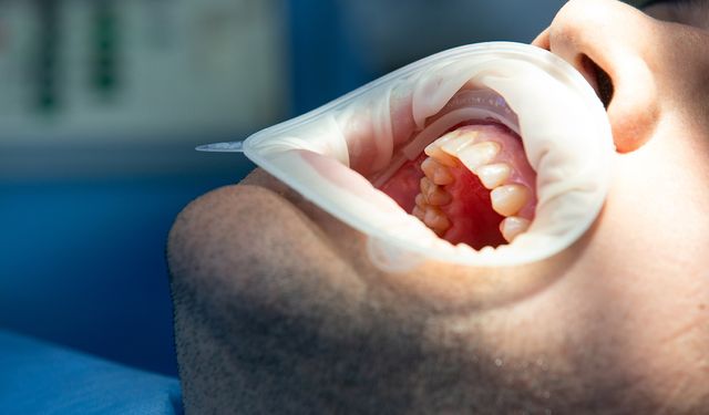 Diş taşı oluşumu nedir, tedavi yöntemleri nelerdir?