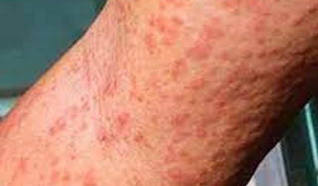 Çin'de 7 binden fazla "chikungunya" virüsü vakası tespit edildi