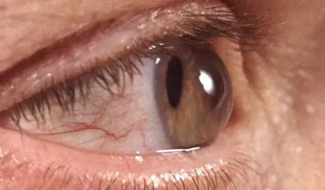 Kışla birlikte gelen göz enfeksiyonlarına dikkat! Uzmanından kritik uyarı…