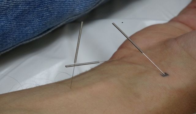 Gaziantep'te akupunktur ile sağlıklarına kavuştular