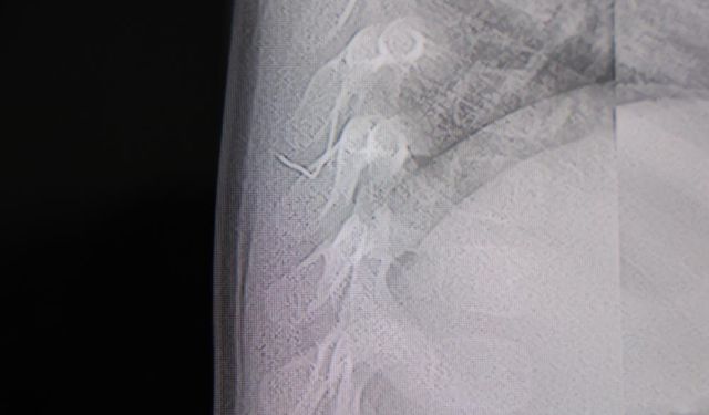 Gaziantep’in komşu ilinde bebeğin sırtından tel parçası çıktı!