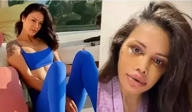 Kore estetiği nedir ve Didem Ceran’ın estetik sürecinde nasıl uygulandı?