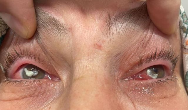 'Kırlangıç otu kullanımı'na dikkat! Uzmanlar uyarıyor: "Gözlerine suyunu damlattı, göremez hale geldi"