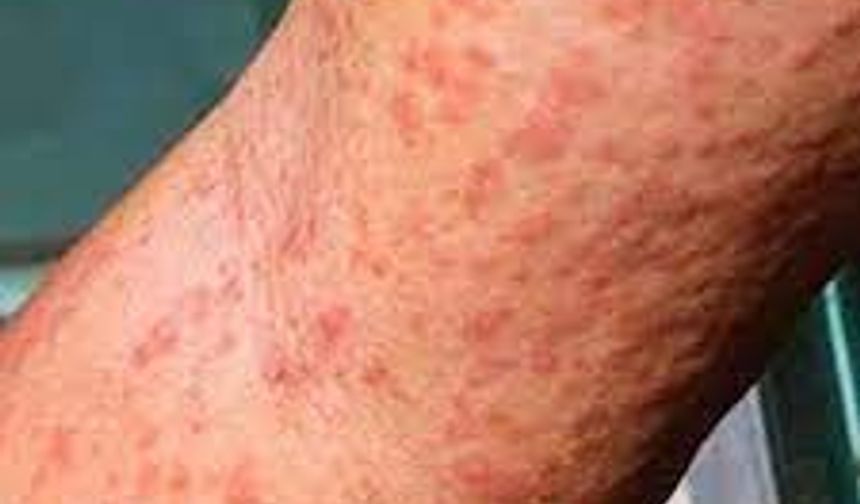 Çin'de 7 binden fazla "chikungunya" virüsü vakası tespit edildi