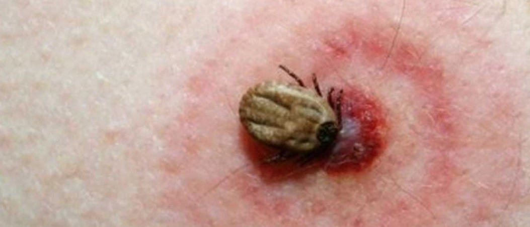Enfeksiyon Hastalıkları Klinik Mikrobiyoloji Uzmanı Dr. Ayşin Kılınç Toker ise, “Yaz aylarının gelmesiyle birlikte özellikle Kırım Kongo Kanamalı Ateşi ve diğer hastalıkları bulaştıran keneler aktif hale geldiler. Hızla çoğaldılar ve insanlara ile hayvanlara bulaşma riskleri arttı. Türkiye’de bu virüsü ilk olarak 2002 yılında İç Anadolu ve Kuzeydoğu bölgelerinde görmeye başladık. Ancak, iklim değişiklikleri, artan sıcaklık ve hayvancılık faaliyetlerindeki artışla birlikte Kayseri ve güney illerinde de Kırım Kongo vakalarında artış yaşanmaktadır” şeklinde konuştu.