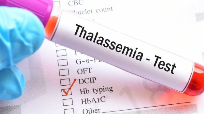 AKDENİZ ANEMİSİ TÜRLERİ NELERDİR?

Talasemi hastalığının üç ana türü vardır:
•	Talasemi Minör: Beta talasemi taşıyıcılığı olarak da bilinir. Hastalığın semptomları genellikle hafiftir ve hastalar normal bir yaşam sürdürebilir. Ancak doğacak çocuklara bozuk gen aktarımı riski vardır.
•	Talasemi Majör: En ciddi türdür. Taşıyıcı anne ve babadan doğan çocuklarda belirtiler bebeklikten itibaren görülür. Tedavi edilmediğinde ciddi komplikasyonlara yol açabilir.
•	Talasemi Intermedia: Minör ile majör arasında bir formdur. Semptomlar genellikle majör kadar ciddi değildir, ancak yaşam boyu devam eder.
