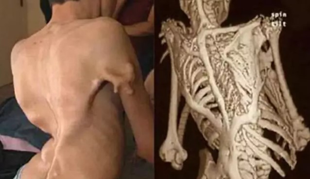 STONEMAN SENDROMU
Halk arasında "taş adam" sendromu olarak bilinen bu hastalık, tendonlar ve kasları yavaş yavaş kemiğe dönüştürerek vücudu sertleştirir. Hareket kısıtlılığına ve ağrılara sebep olan bu sendromun tedavisi maalesef bulunmamaktadır.
